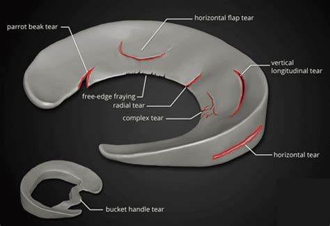 Meniscal Tears 